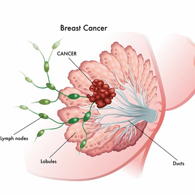 بیماری سرطان سینه