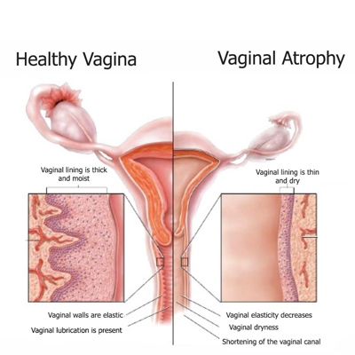 درمان خشکی واژن