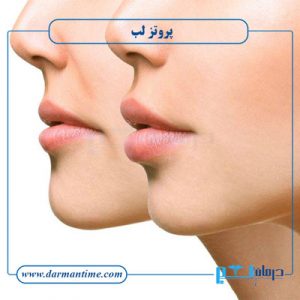 پروتز لب
