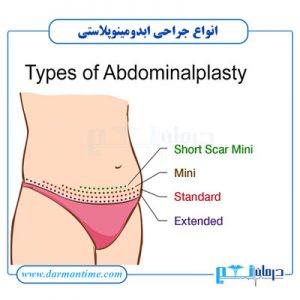 انواع جراحی ابدومینوپلاستی