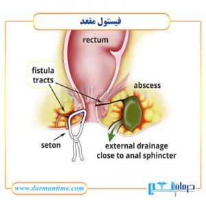 درمان فیستول با لیزر