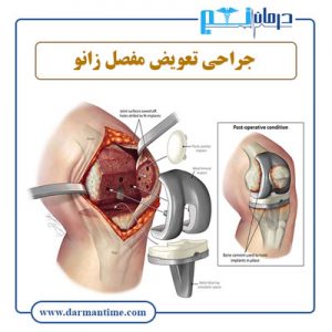 هزینه تعویض مفصل زانو