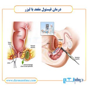 لیزر فیستول