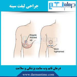 جراحی لیفت سینه