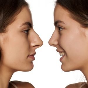 حفظ عملکرد بینی بعد از جراحی بینی