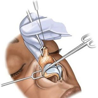 جراحی بینی باز