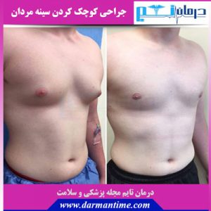 جراحی کوچک کردن سینه مردان