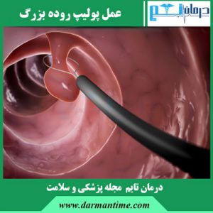 عمل پولیپ روده بزرگ