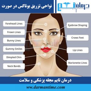 نواحی تزریق بوتاکس صورت
