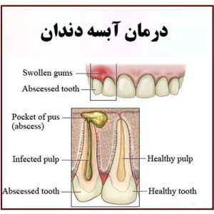 نحوه تخلیه آبسه دندان
