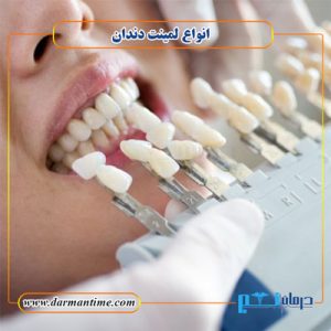 انواع لمینت دندان