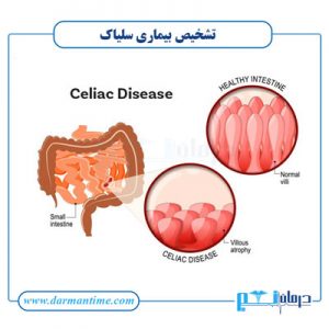 تشخیص قطعی سلیاک