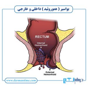 بواسیر داخلی و خارجی