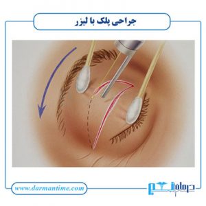 جراحی پلک با لیزر