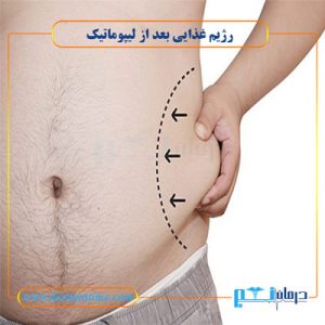 رژیم غذایی پس از عمل لیپوماتیک