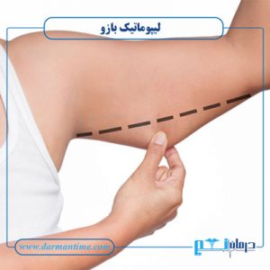 لیپوماتیک بازو