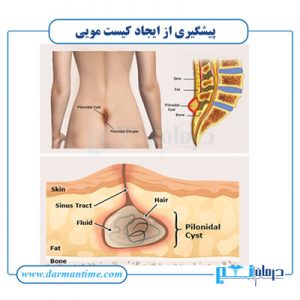پیشگیری از کیست مویی