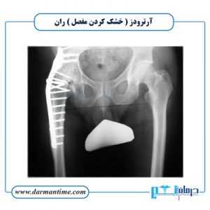 آرترودز