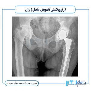 آرتروپلاستی ران