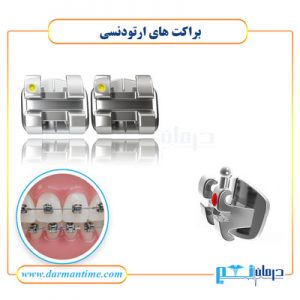 براکت های ارتودنسی