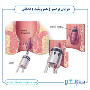 درمان بواسیر یا هموروئید داخلی