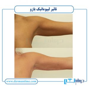 تاثیر لیپوماتیک بازو
