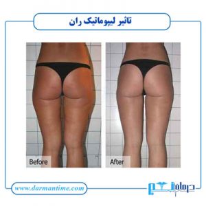هزینه لیپوماتیک رانها