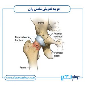 هزینه تعویض مفصل ران