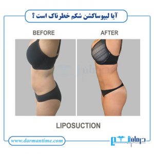 آیا لیپوساکشن شکم خطرناک است