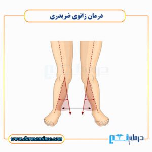 درمان زانوی ضربدری