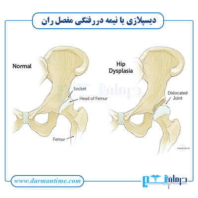 دیسپلازی یا نیمه دررفتگی مفصل ران