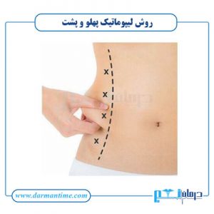 روش لیپوماتیک پهلو و پشت