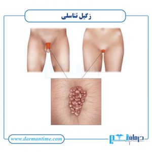 علائم زگیل تناسلی در زنان و مردان