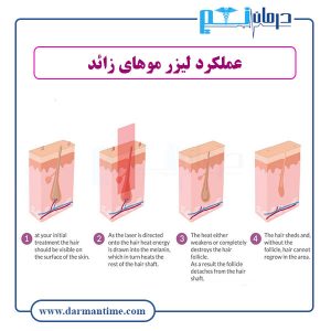 تعداد جلسات لیزر موهای زائد