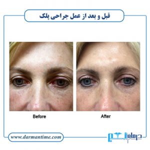 نتایج لیزر پلک