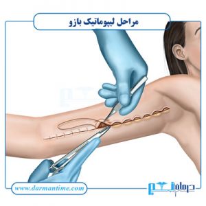 مراحل لیپوساکشن بازو