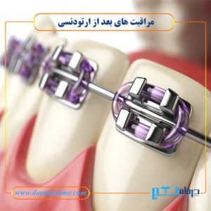 مراقبت های بعد از ارتودنسی