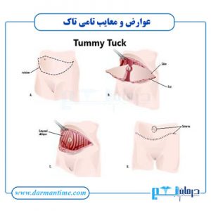 معایب تامی تاک