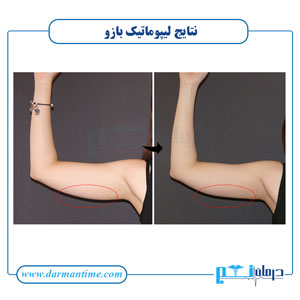 تصاویر لیپوماتیک بازو