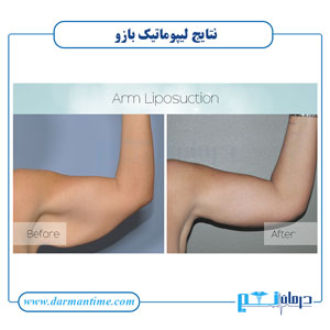 تصاویر لیپوماتیک بازو