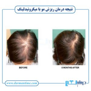 نتیجه میکرونیدلینگ مو