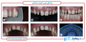 لمینت دندان
