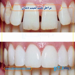 مراحل نصب لمینت دندان