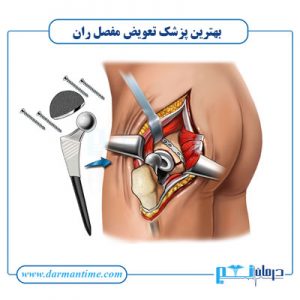 بهترین پزشک ارتوپد برای تعویض مفصل ران