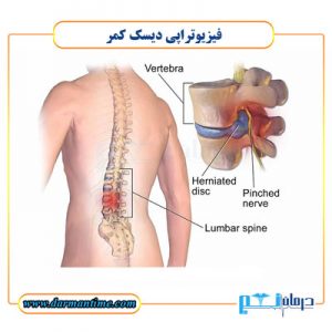 فیزیوتراپی دیسک کمر