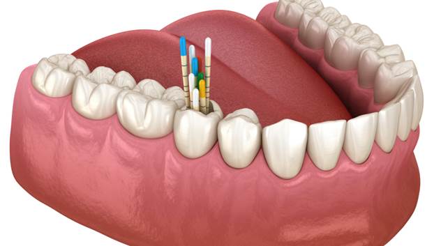 انواع گوتا دندانپزشکی و کاربرد آن ها