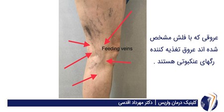 درمان واریس با تزریق