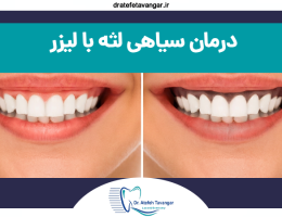 درمان سیاهی لثه با لیزر در کلینیک دکتر عاطفه توانگر