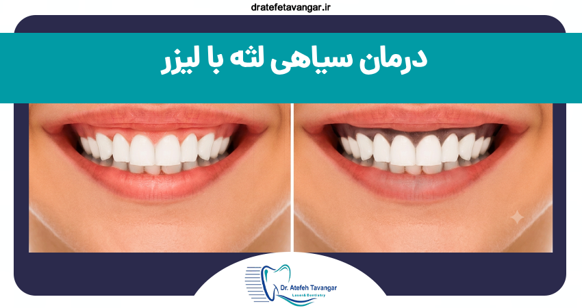 درمان سیاهی لثه با لیزر در کلینیک دکتر عاطفه توانگر