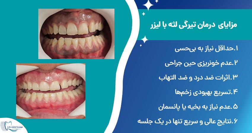 مزایای درمان تیرگی لثه با لیزر